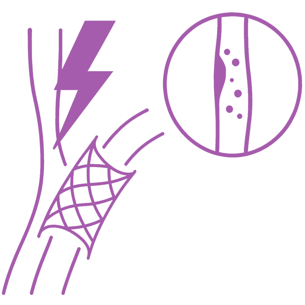 Carotid Artery Stenting